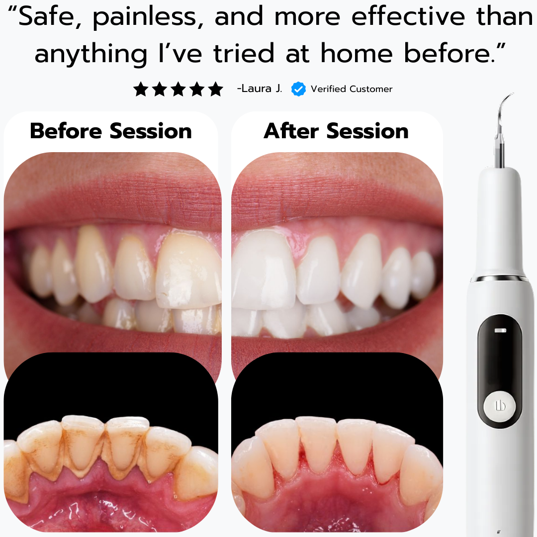 SmiSonic™ Home Tooth Cleaner – At-Home Solution for Tartar, Stains & Bad Breath
