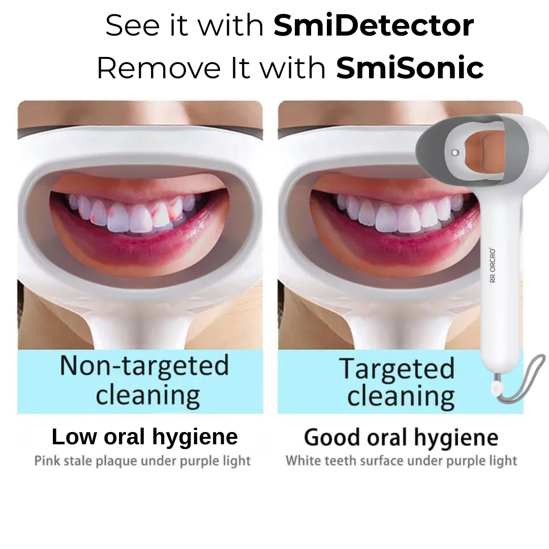 SmiVox SmiDetector™ - Expose Invisible Build-Up Before It Hardens