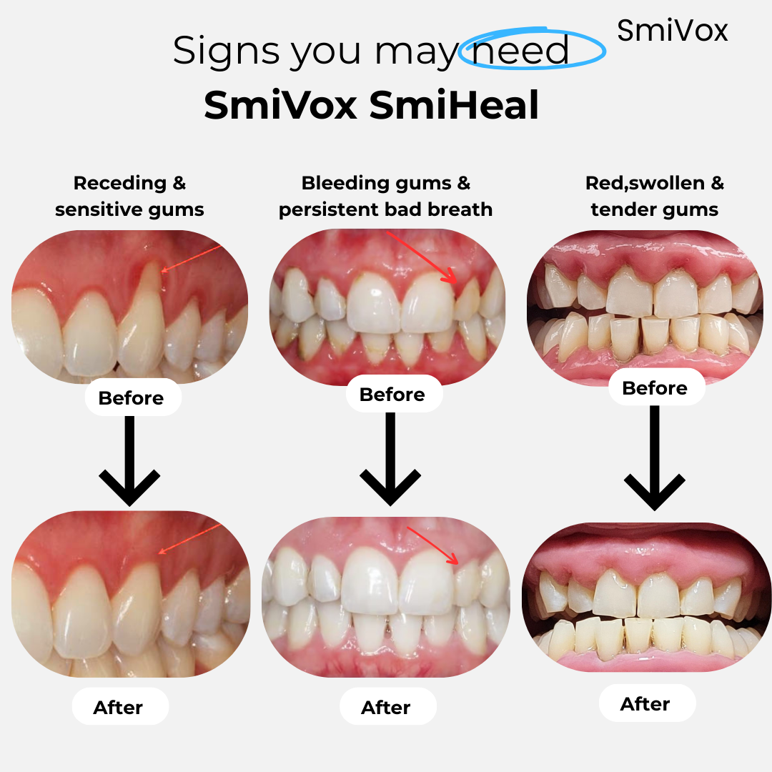 SmiVox™ SmiHeal Gum & Periodontal Light Therapy Device, Results in 14 days