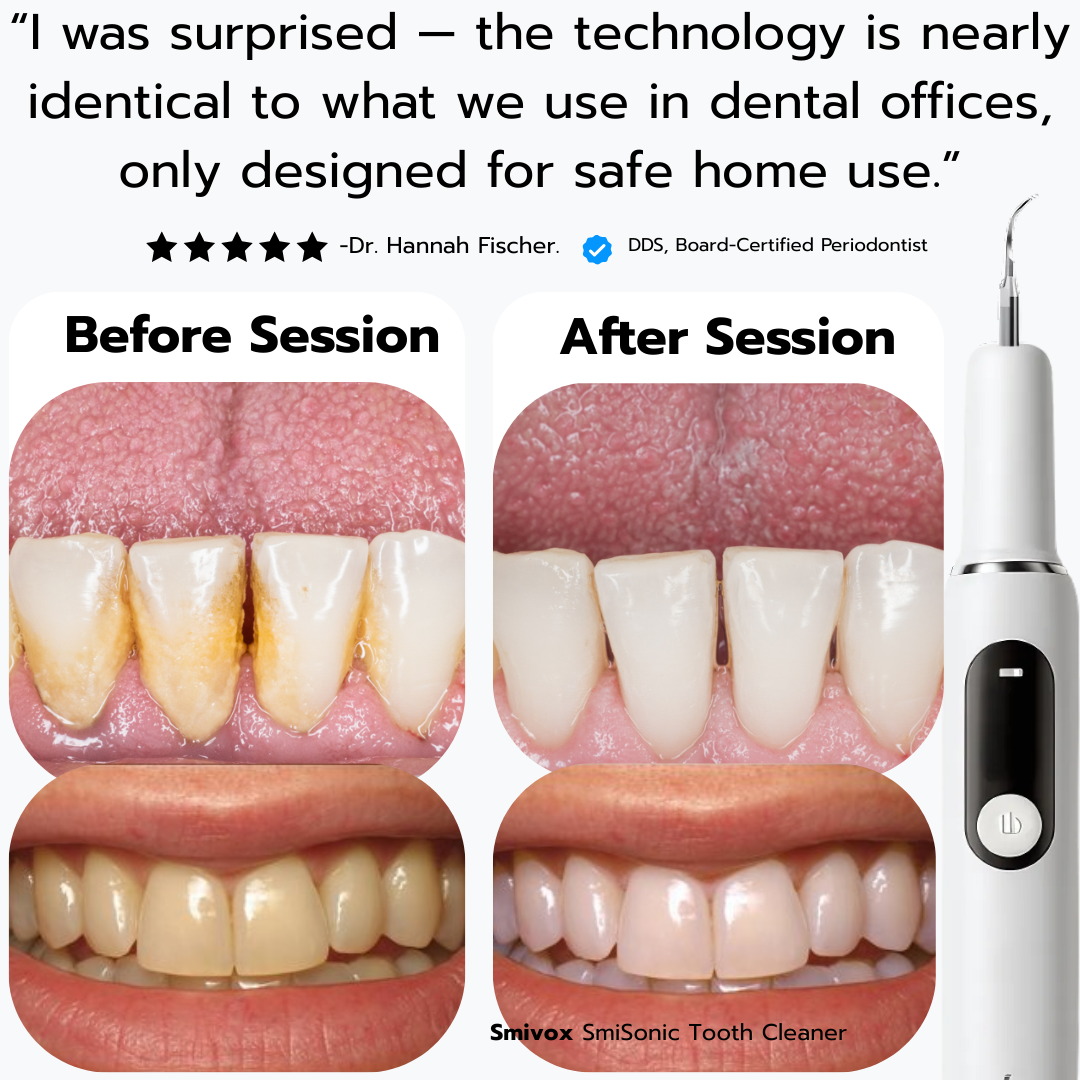 SmiSonic™ Home Tooth Cleaner – At-Home Solution for Tartar, Stains & Bad Breath