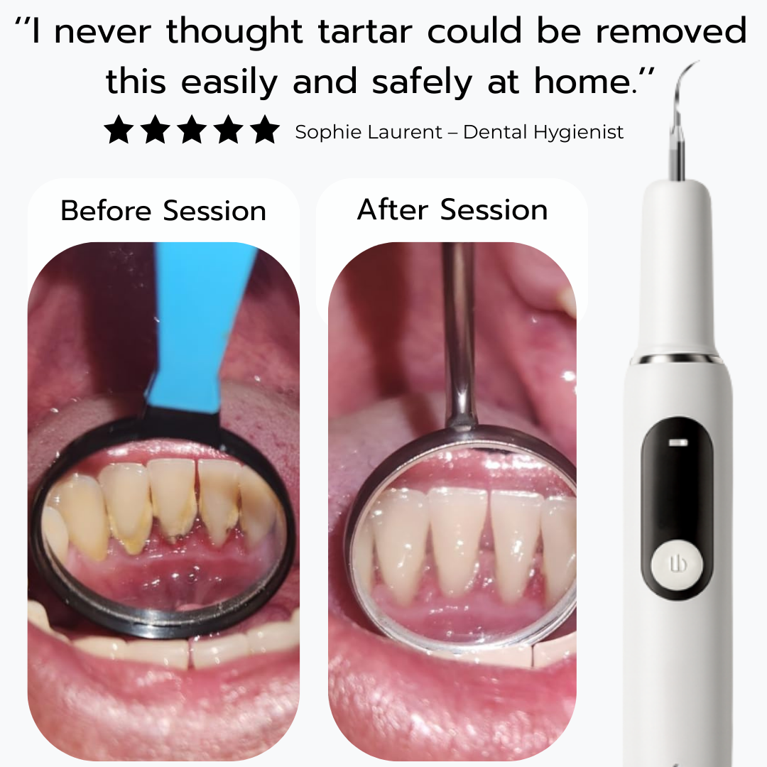 SmiSonic™ Home Tooth Cleaner – At-Home Solution for Tartar, Stains & Bad Breath