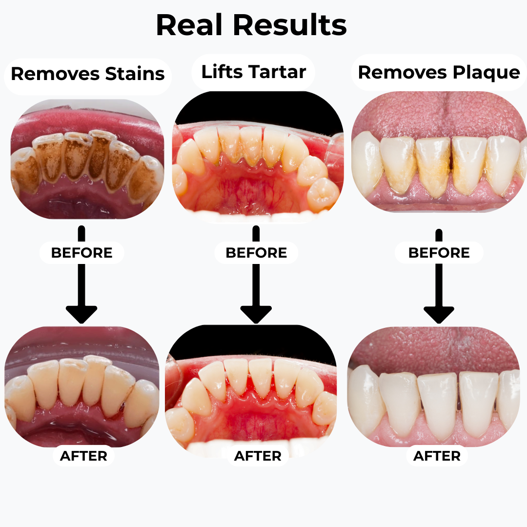 SmiSonic™ Home Tooth Cleaner – At-Home Solution for Tartar, Stains & Bad Breath